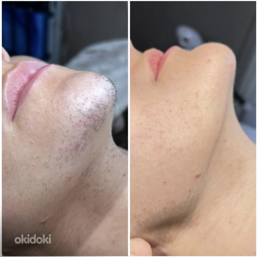 Мужская и Женская Электроэпиляция ДО -30%