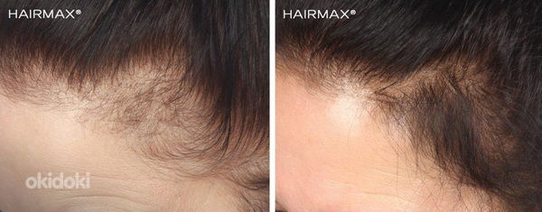Курс против выпадения волос (фото #6)