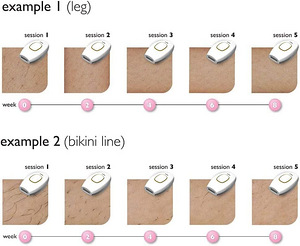 Bikinis Pulses Epilator Painless Laser- Hair Removal Facial (5 foto / 8)